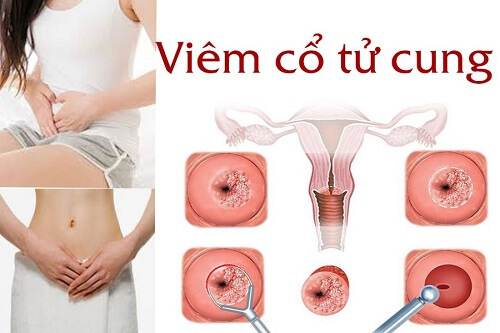 Khí hư màu trắng đục và ngứa cảnh báo bệnh viêm cổ tử cung